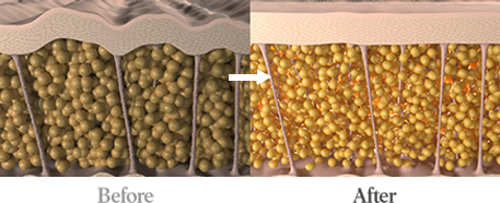 온다리프팅이미지