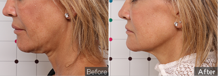 온다리프팅이미지