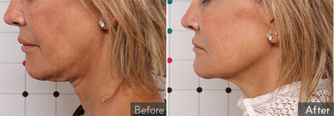 온다리프팅이미지